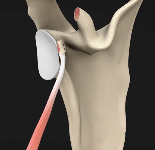 Latarjet Procedure Brooklyn NY | Shoulder Instability Manhattan