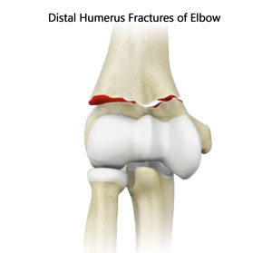 Distal Humerus Fractures of the Elbow