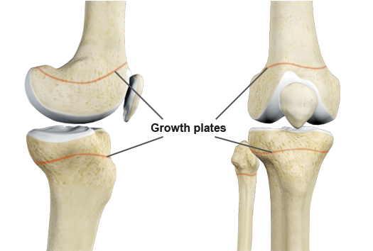 Growth Plate Fractures